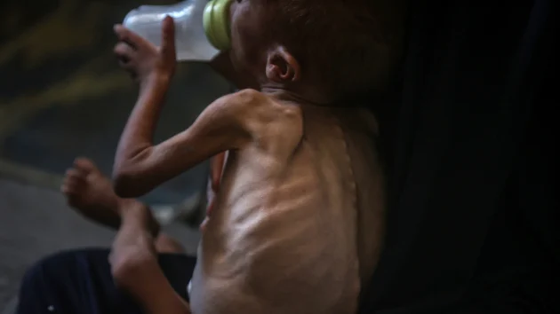 ‘They’re losing hope’: What doctors, aid workers are seeing in Gaza amid hunger crisis