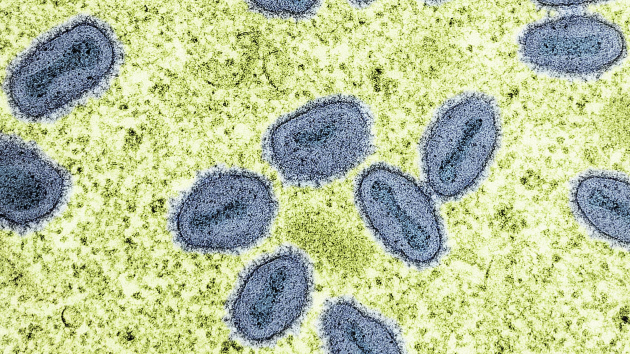 California officials confirm 1st US case of severe mpox strain with no travel history